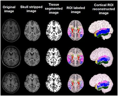 Automated detection of MRI-negative temporal lobe epilepsy with ROI-based morphometric features and machine learning